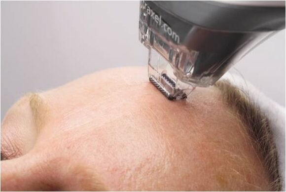 procedura di peeling per il ringiovanimento della pelle del viso